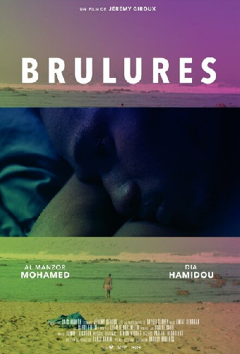 Brûlures